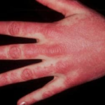 Unveiling Dermatomyositis: The Complexities of a Rare Inflammatory Disorder